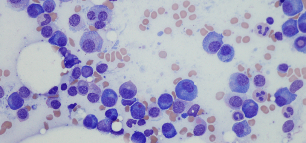 Bone Marrow vs. Cord Blood Stem Cell Transplant | Americord Registry
