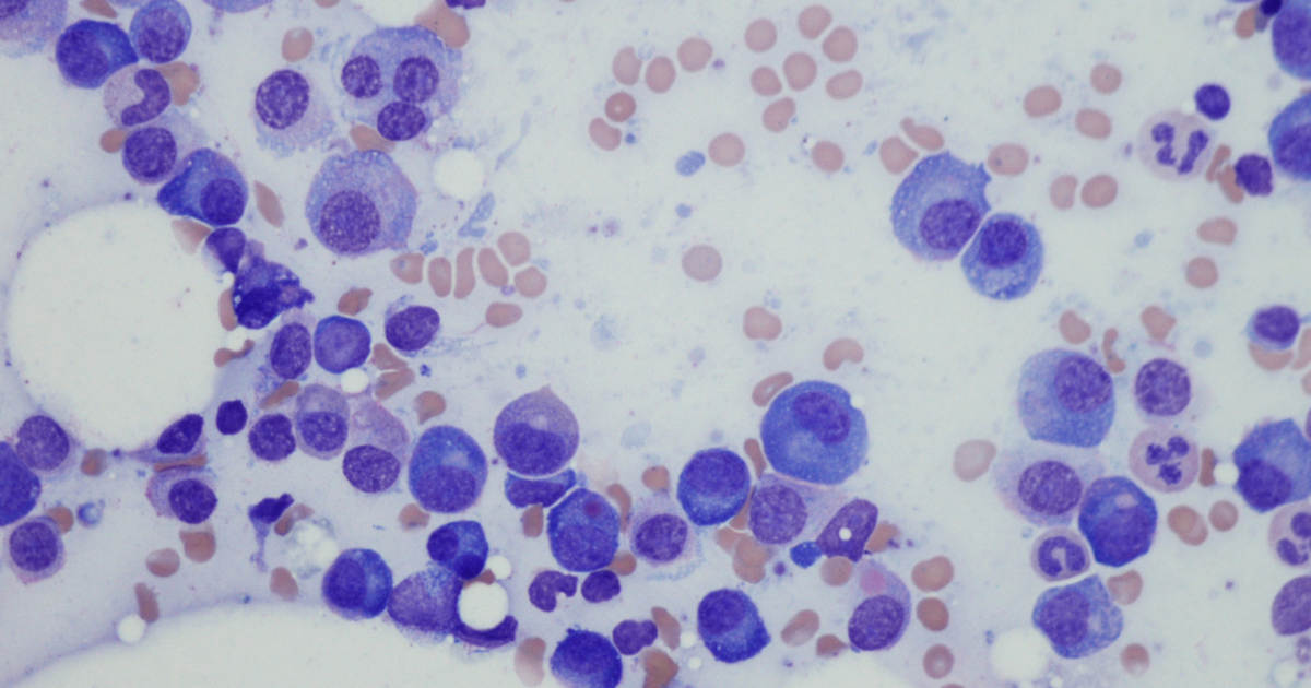 Bone Marrow vs. Cord Blood Stem Cell Transplant Americord Registry